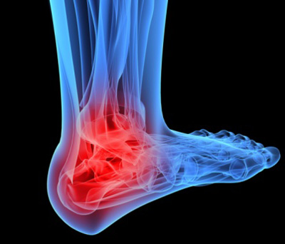 Wake up call - What is causing your foot pain? - Washington University ...